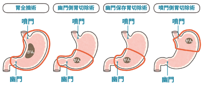 胃がんの手術